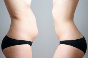 2カ月で25kg減量した女性に待ち受けていた「ダイエットの弊害」