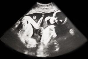 双子・赤ちゃん・エコー写真