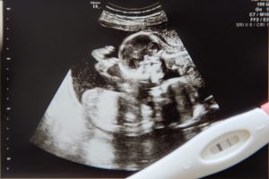 双子を妊娠した女性が10日後の排卵でまた受胎　「重複妊娠」でお腹に3人の子