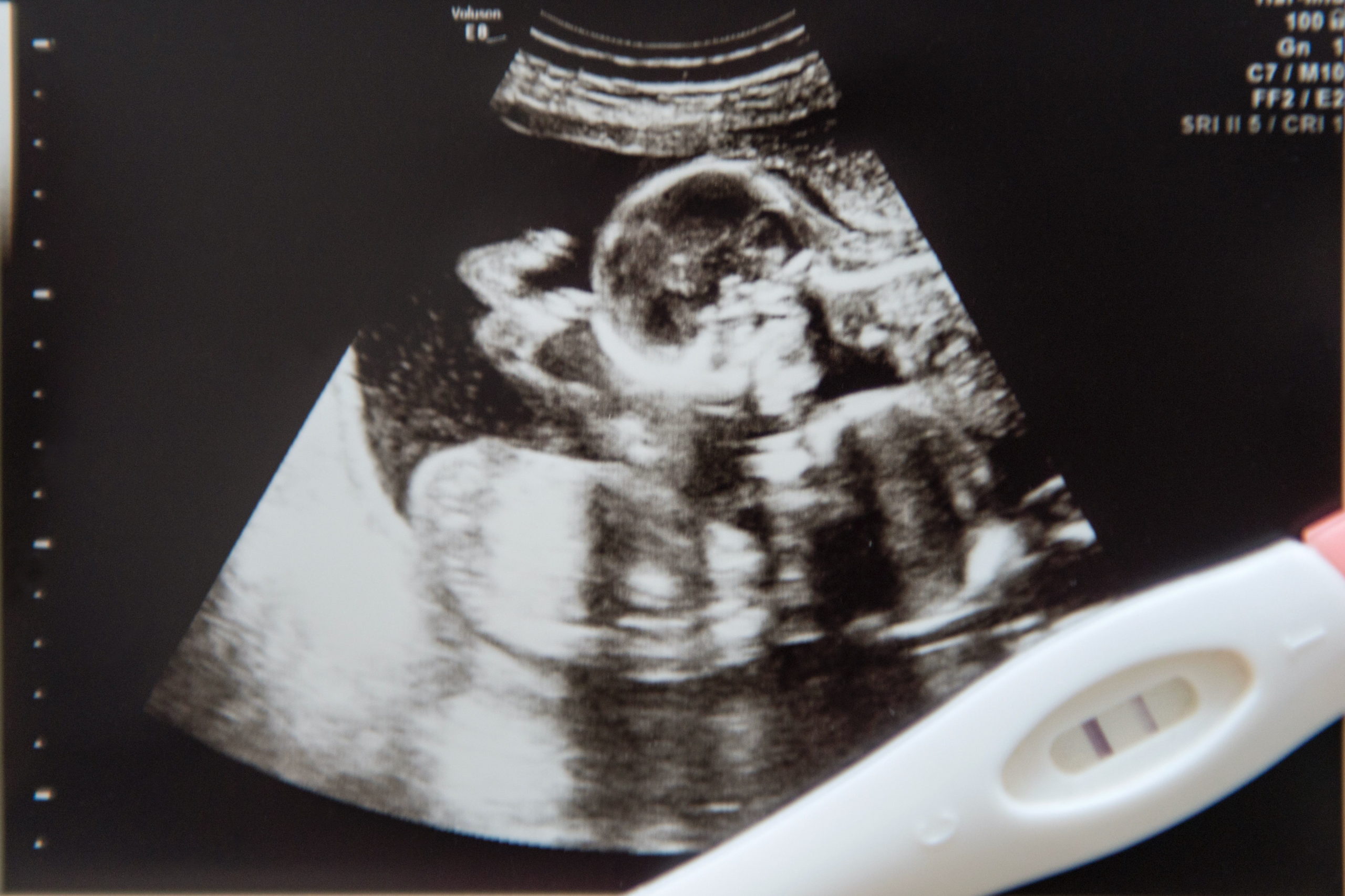 双子を妊娠した女性が10日後の排卵でまた受胎 重複妊娠 でお腹に3人の子 Sirabee