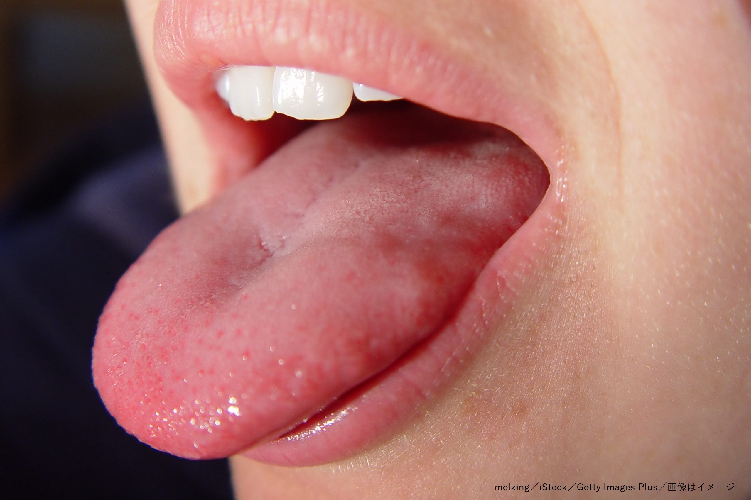 Соленая слюна во рту. Гипопластический глоссит.
