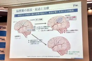 若者にも増える脳梗塞！　医師に聞いた「明日からできる予防法」と新薬の可能性
